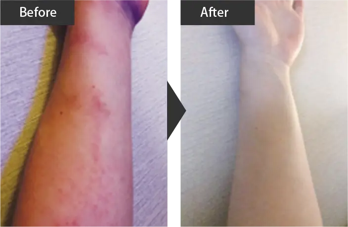 Dermatitis Part 1 Before and after treatment