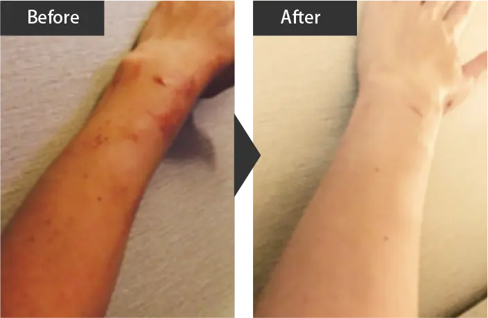 Dermatitis Part 2 Before and after treatment