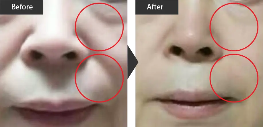 beauty skin regeneration (Sagging improvement) Before and after treatment