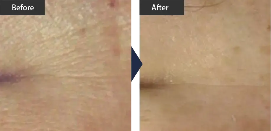 beauty skin regeneration (Wrinkle improvement) Before and after treatment