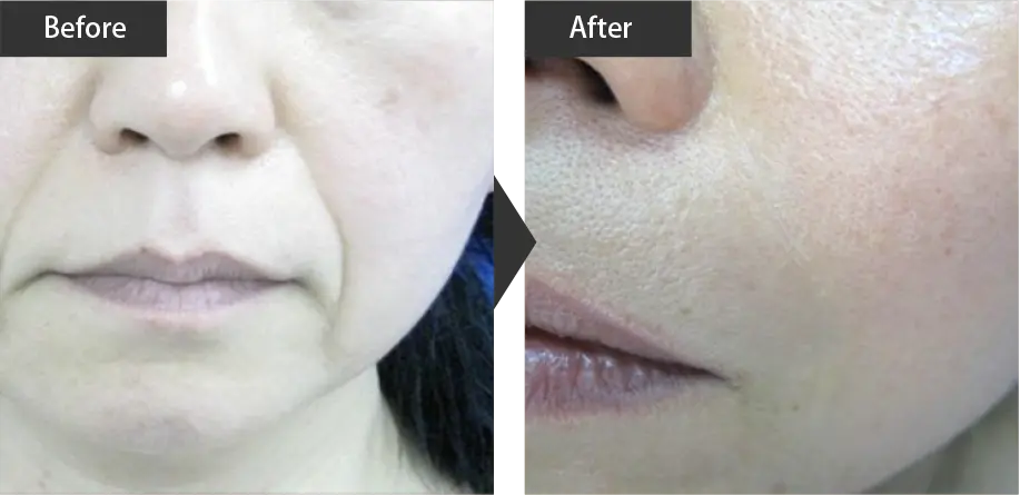 beauty skin regeneration (Improvement of nasolabial folds) Before and after treatment