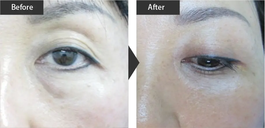 beauty skin regeneration (Improvement of bags under the eyes) Before and after treatment