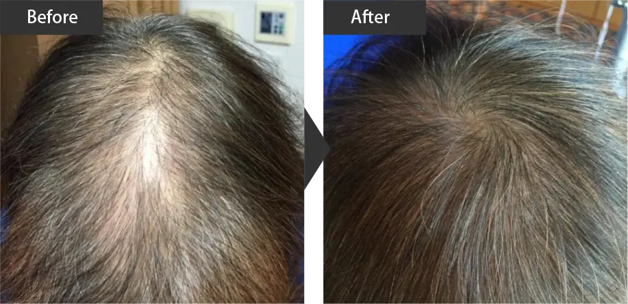 Before and after hair growth treatment